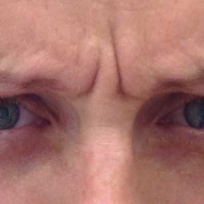 Botox / toksyna botulinowa