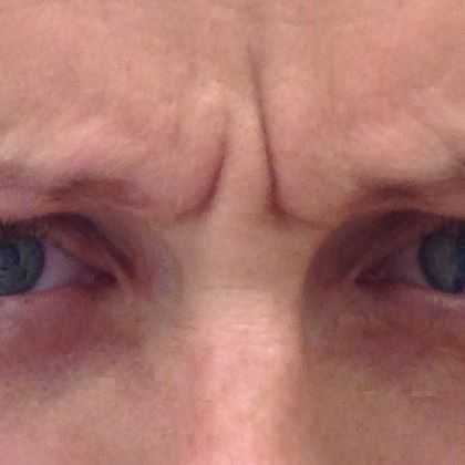 Botox / toksyna botulinowa