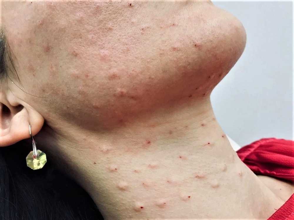 MEZOTERAPIA