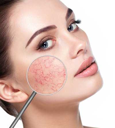 Laser naczyniowy Nd:Yag LongPulse® 